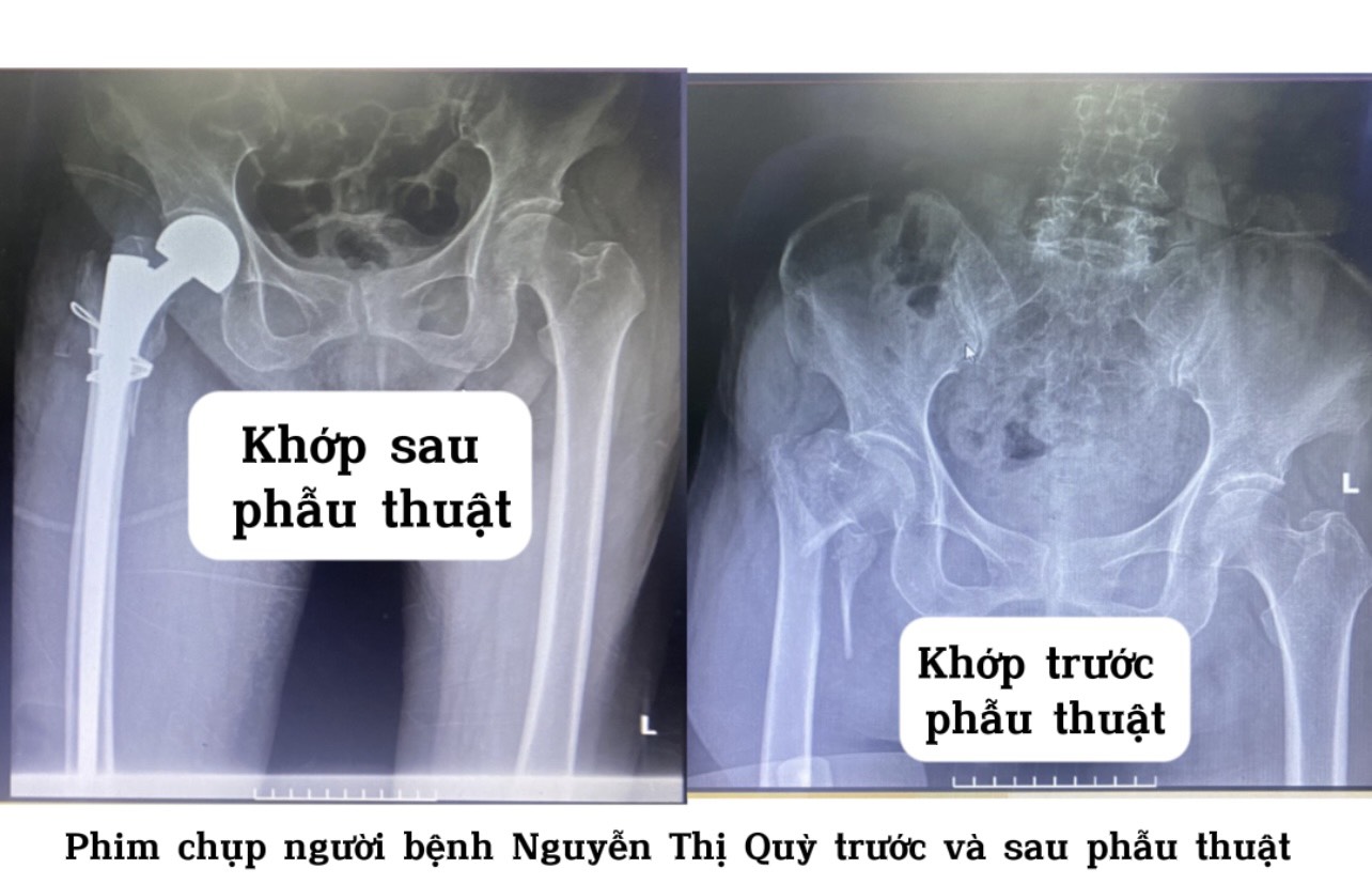 2 NGƯỜI BỆNH 100 TUỔI ĐƯỢC PHẪU THUẬT THAY KHỚP HÁNG THÀNH CÔNG