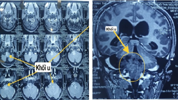 U BAO RỄ THẦN KINH LỖ CẢNH