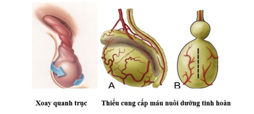 XOẮN TINH HOÀN TRẺ EM